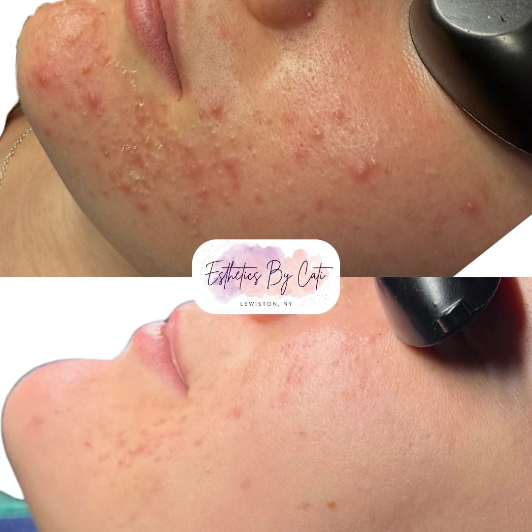 Jawline Acne Transformation in Lewiston NY - Esthetics By Cati