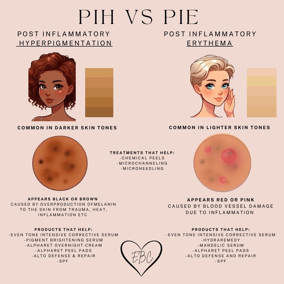 PIH vs PIE: Understanding Acne Marks and How to Treat Them - Esthetics By Cati