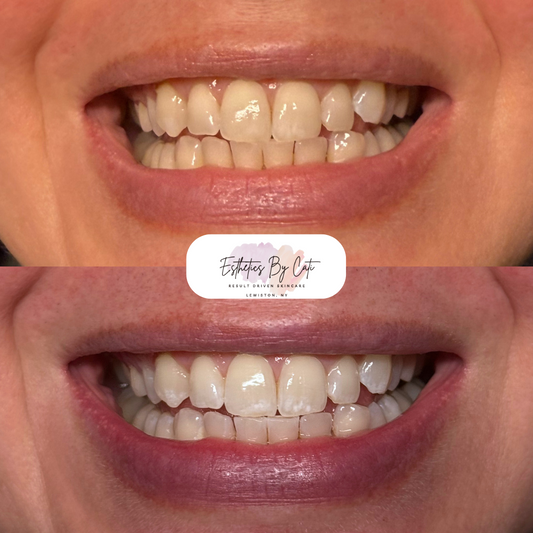 Teeth Whitening 2