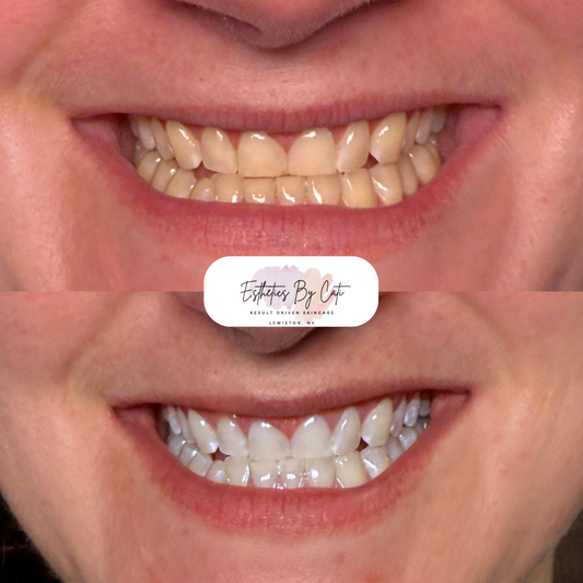Teeth Whitening 4