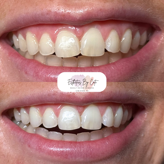 Teeth Whitening 6