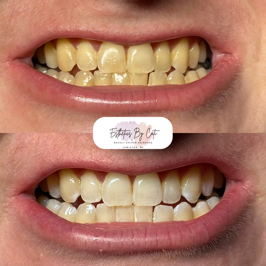 Teeth Whitening 5