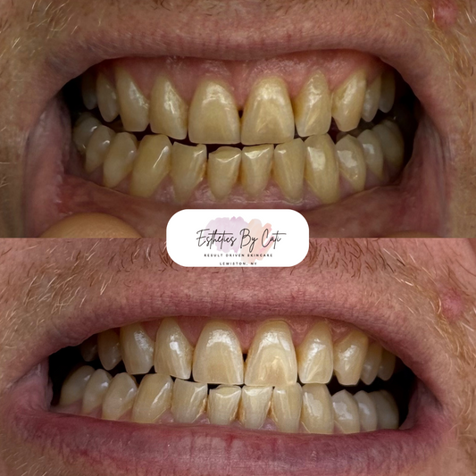 Teeth Whitening 3