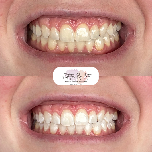 Teeth Whitening 1