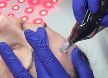 Microneedling Packages with Cati